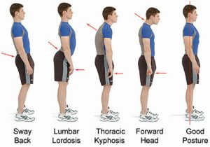 https://www.completechiropractic.co.uk/wp-content/uploads/2017/12/posture-problems-chiropractic-300x210.jpg